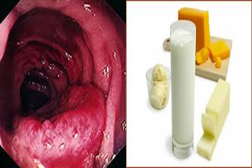 بكتيريا وراثية بمنتجات الألبان لمكافحة الالتهابات المزمنة للامعاء