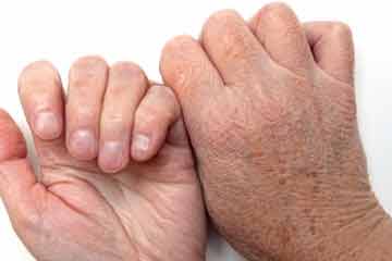 جفاف الجلد يكشف عن الاصابة ببعض الامراض