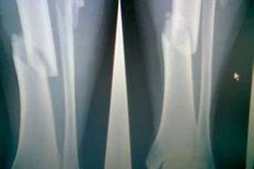 ابتكار جهاز يعمل بالنبضات الصوتية لعلاج كسور العظام