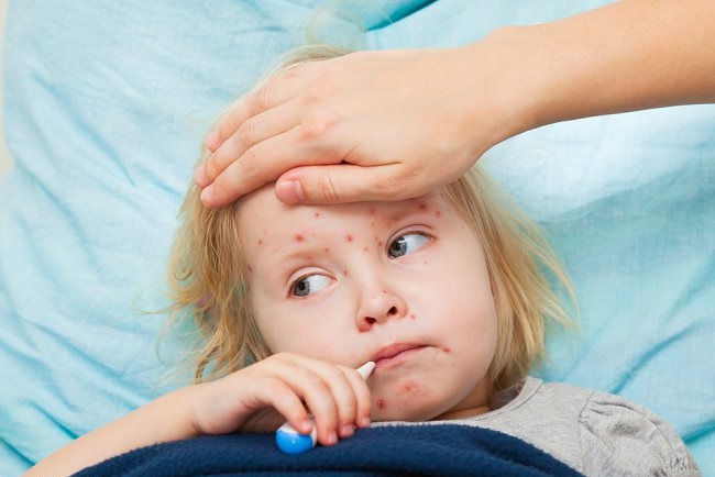 الصحة: وفاة 4 وإصابه 60 طفل بالحصبة بواحة سيوة