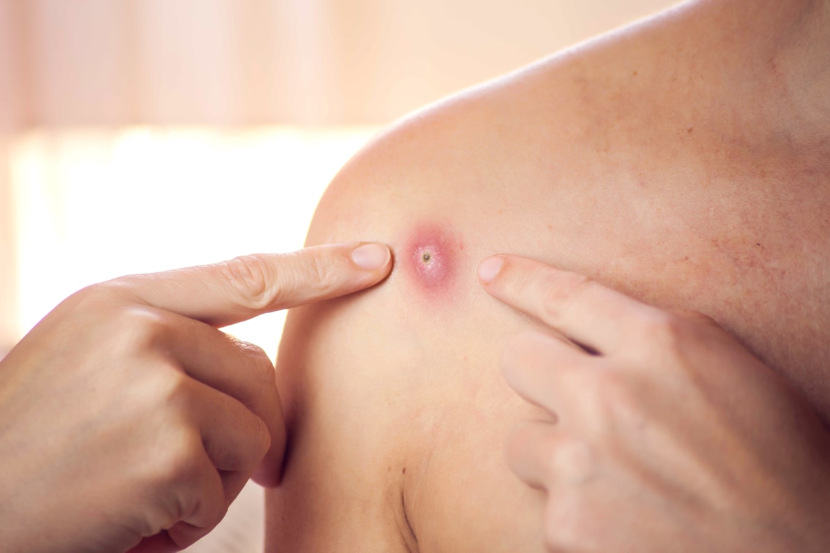 جدري القرود ؛ جدرى القرود