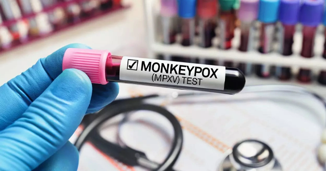 جدري القرود