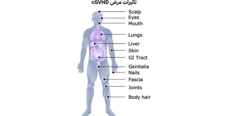 ما بعد زراعة النخاع العظمي؟